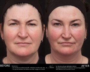 Anti-Wrinkle Treatment BA Image