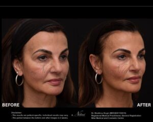 Dermal Treatment BA Image