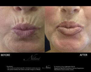 Smokers Lines Treatment BA Image