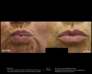 Smokers Lines Treatment BA Image
