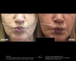 Smokers Lines Treatment BA Image