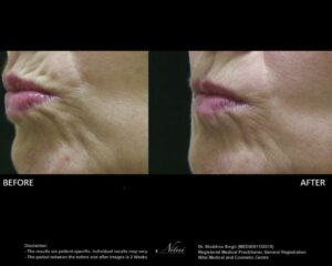 Smokers Lines Treatment BA Image
