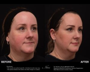 Dermal Treatment BA Image