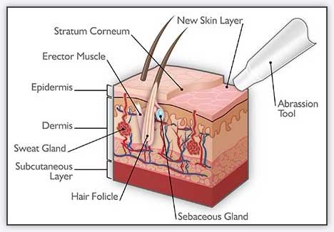Microdermabrasion for acne - How it works