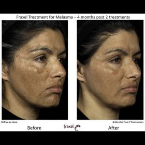 Fraxel treatment for Melasma, before and after 02-2
