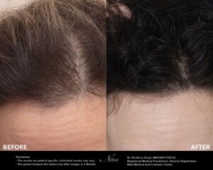 Hair Transplant Treatment BA Image