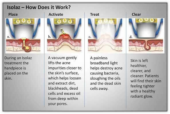 How doeas it work: Isolaz Acne Therapy