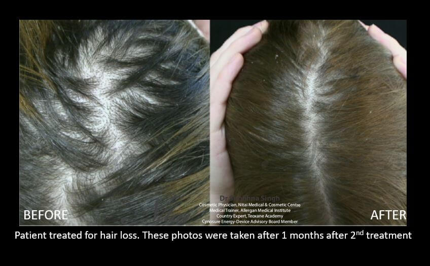 PRP hair treatment results 03, Nitai Clinic Melbourne