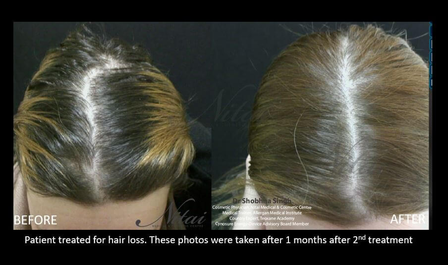 PRP hair treatment results 03-2, Nitai Clinic Melbourne