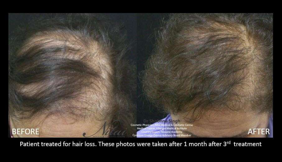 PRP Hair Treatment before and after 01, Nitai Melbourne