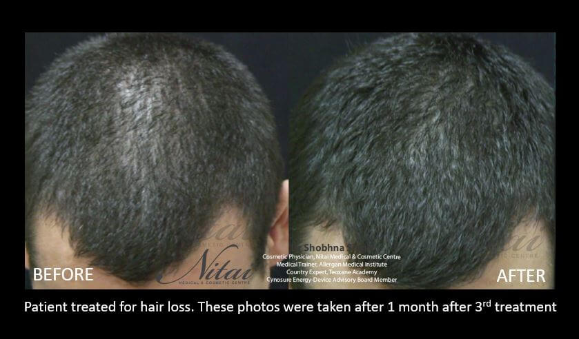 PRP for hair treatment, before and after 04, Nitai Melbourne
