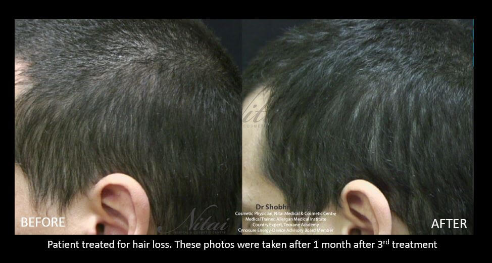 PRP for hair treatment, before and after 04-2, Nitai Melbourne