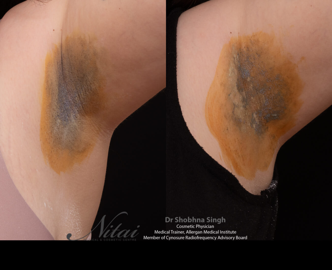 Miradry Before After Images 1 Miradry