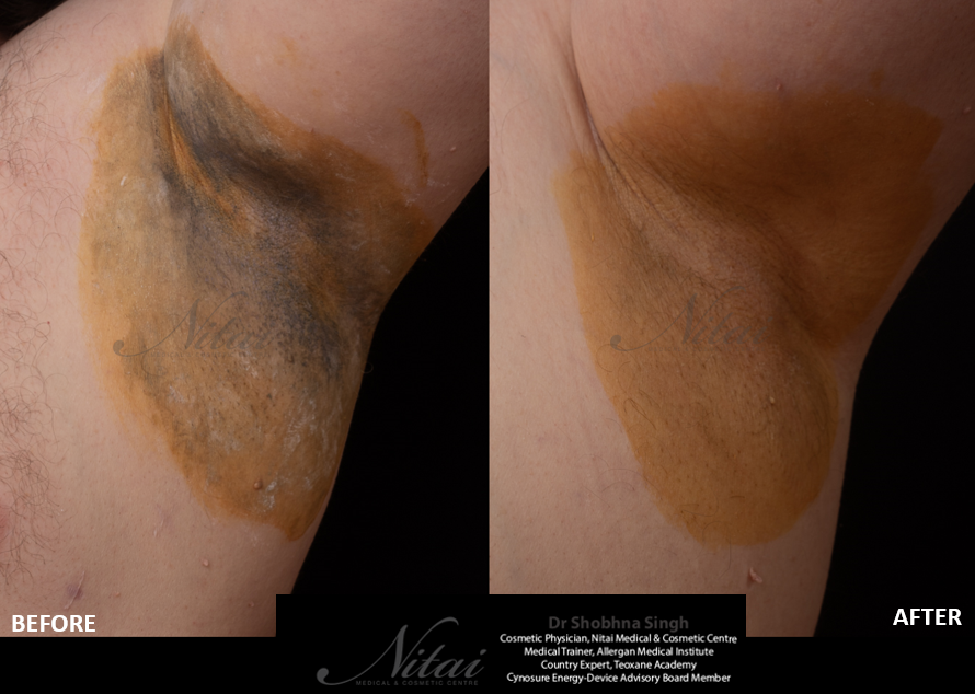 Miradry Before After Images 3 Miradry