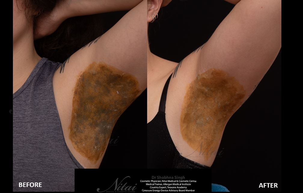 Miradry Before After Images 2 Miradry