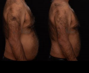StimSure before and after 02, abdomen results on male patient after 4 treatments (Right view)