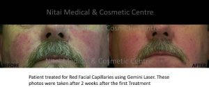 Burst capillaries before and after (results) 01