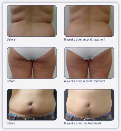 Clatuu body shaping before and after 01, Nitai Clinic Melbourne