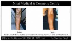Laser tattoo removal before and after 01, Nitai Clinic Glenroy, Melbourne