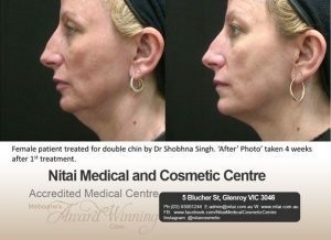 Injectable Double Chin Treatment