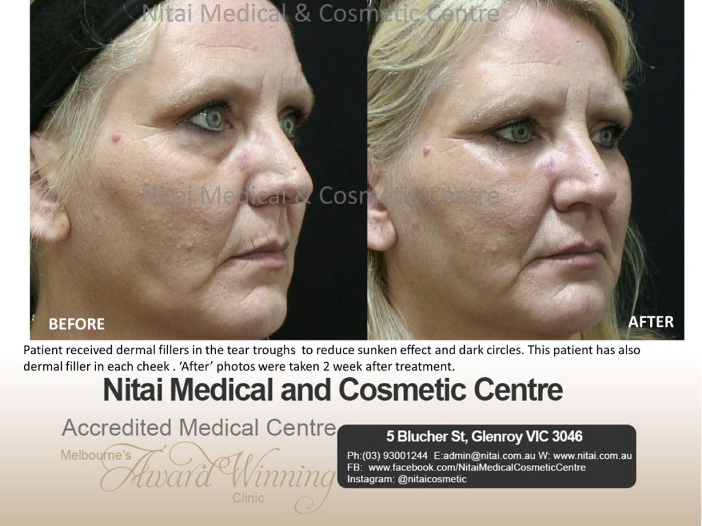 Dermal Fillers Before After | Nitai Clinic