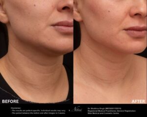 Neck Rejuvenation BA Image