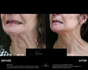 Neck Rejuvenation BA Image
