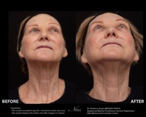 Neck Rejuvenation BA Image