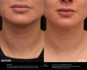 Neck Rejuvenation BA Image