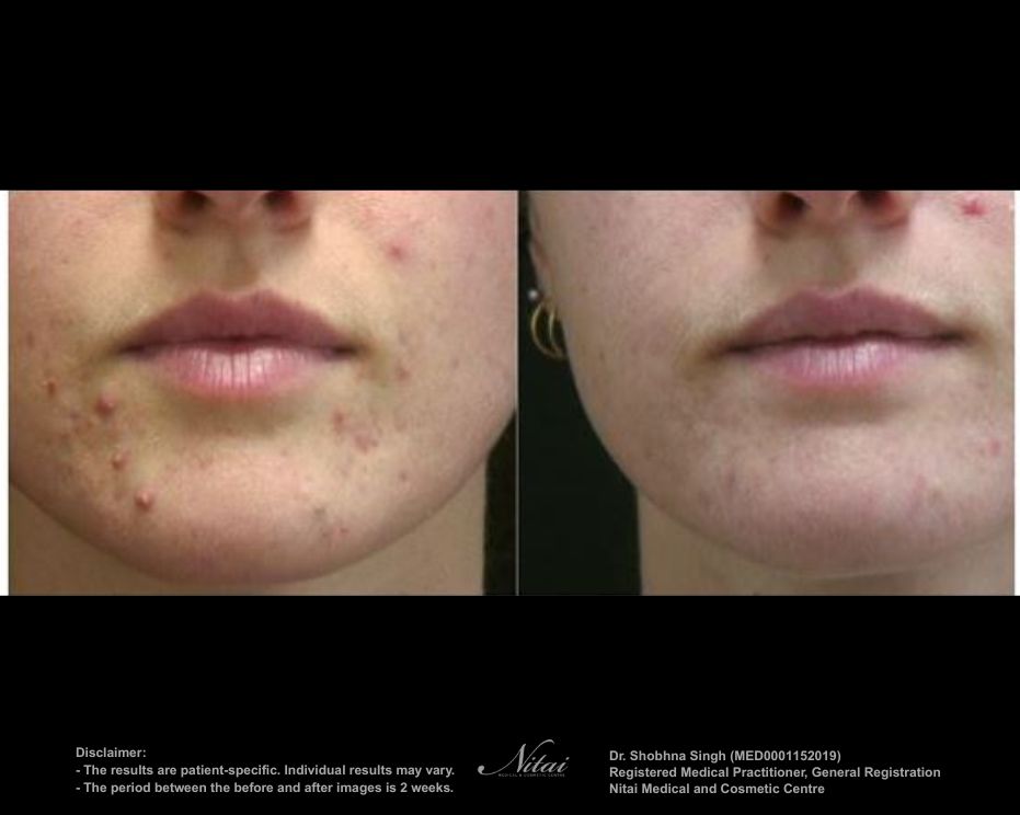 Isolaz Acne Treatment