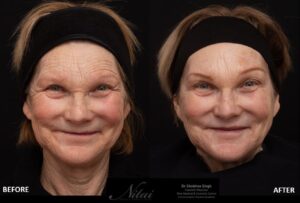 Patient was treated with Anti-Wrinkle Injections