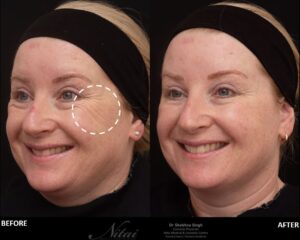 Patient was treated with Anti-Wrinkle Injections