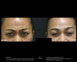 Anti-Wrinkle Treatment BA Image