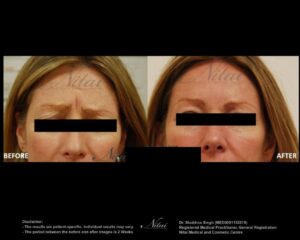 Anti-Wrinkle Treatment BA Image