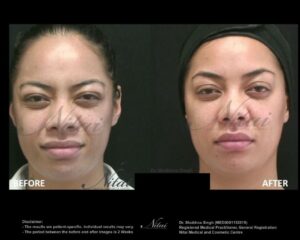 Anti-Wrinkle Treatment BA Image