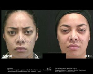 Anti-Wrinkle Treatment BA Image