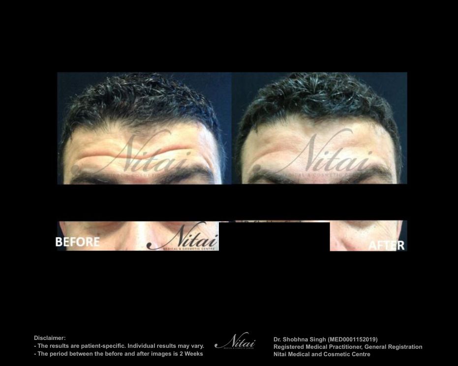 Forehead Wrinkle Lines