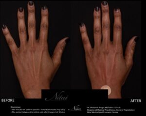Hand-Rejuventation-Treatment-BA Image