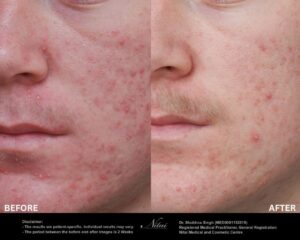 HIFU Treatment BA Image