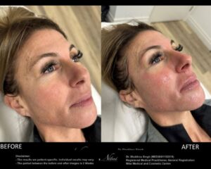 HIFU Treatment BA Image