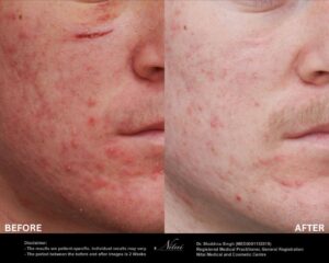 HIFU Treatment BA Image