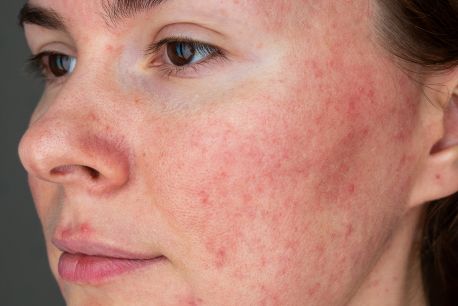8 Tips to Prevent Rosacea Flare-Ups: Your Guide to Clearer Skin