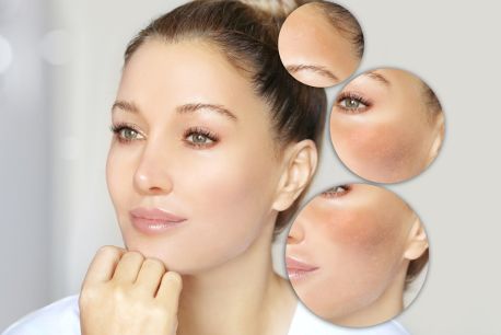 6 Tips to Prevent Melasma: Safeguard Your Skin Today