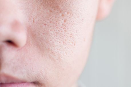What Are Pores and How to Reduce Pore Size