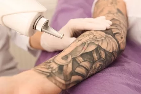 Top Benefits of Laser Tattoo Removal in Melbourne - Laser Skin Treatment  Clinic Melbourne