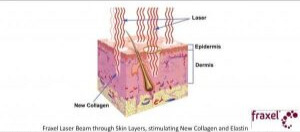 Fraxel laser treatment