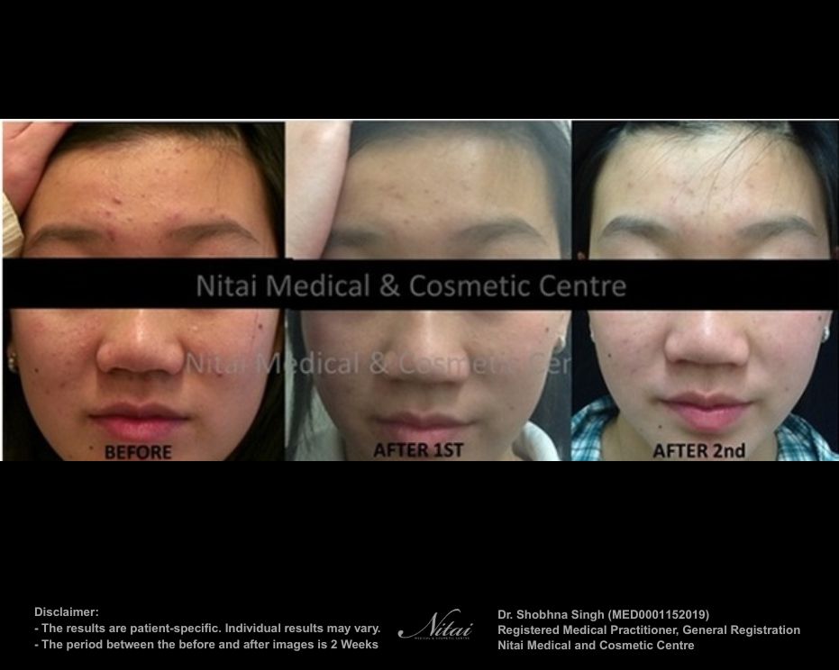 Isolaz Treatment BA Image