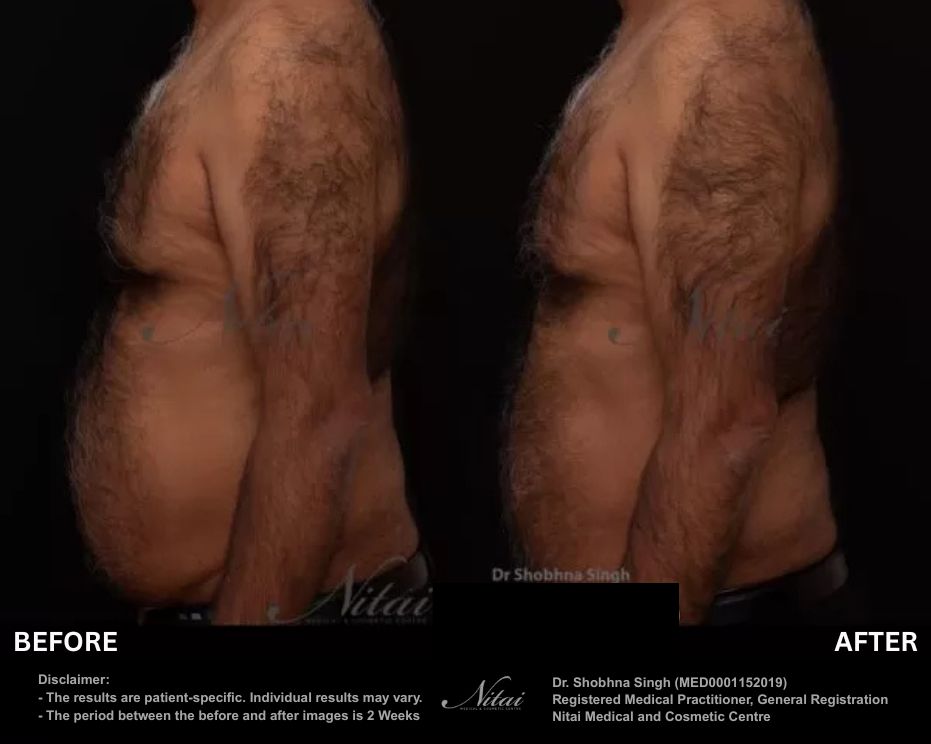 StimSure before and after 03, abdomen results on female patient after 3 treatments
