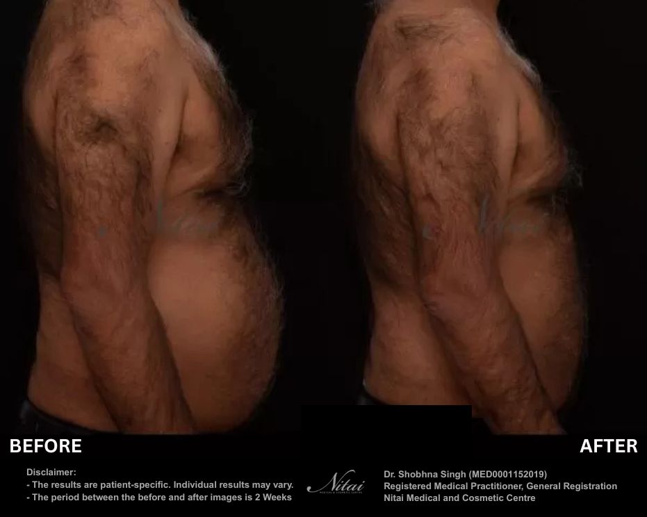 StimSure before and after 02, abdomen results on male patient after 4 treatments (Right view)