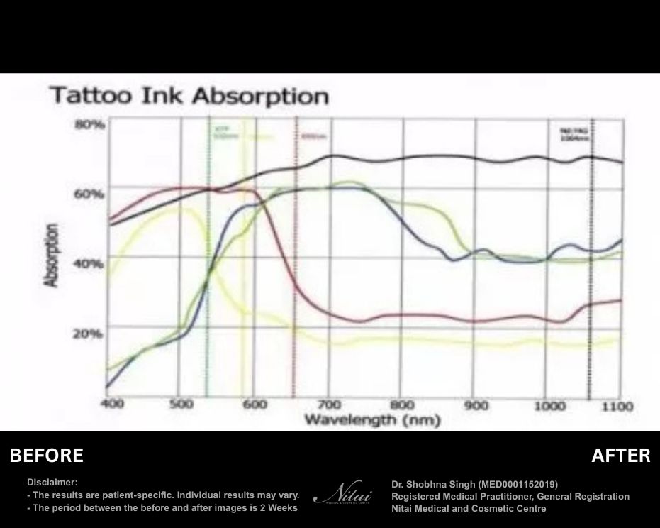 Laser tattoo removal, tattoo ink absorption 01